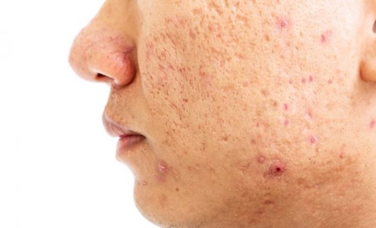 hidradenitis-suppurativa-nedir-ibrahim-saracoglu