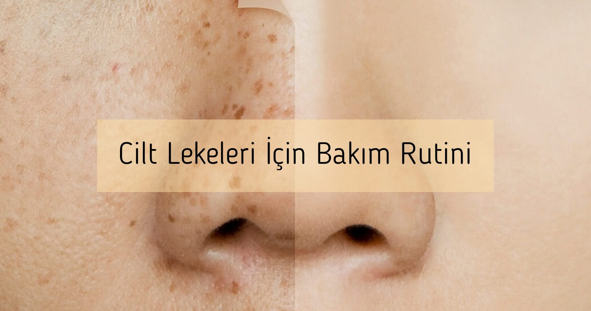 Cilt Lekeleri İçin Bakım Rutini