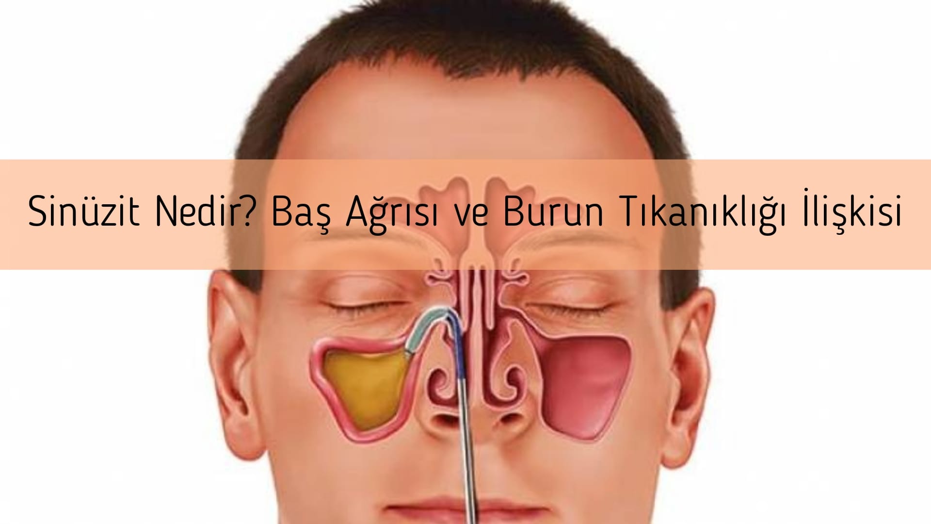Sinüzit Nedir? Baş Ağrısı ve Burun Tıkanıklığı İlişkisi