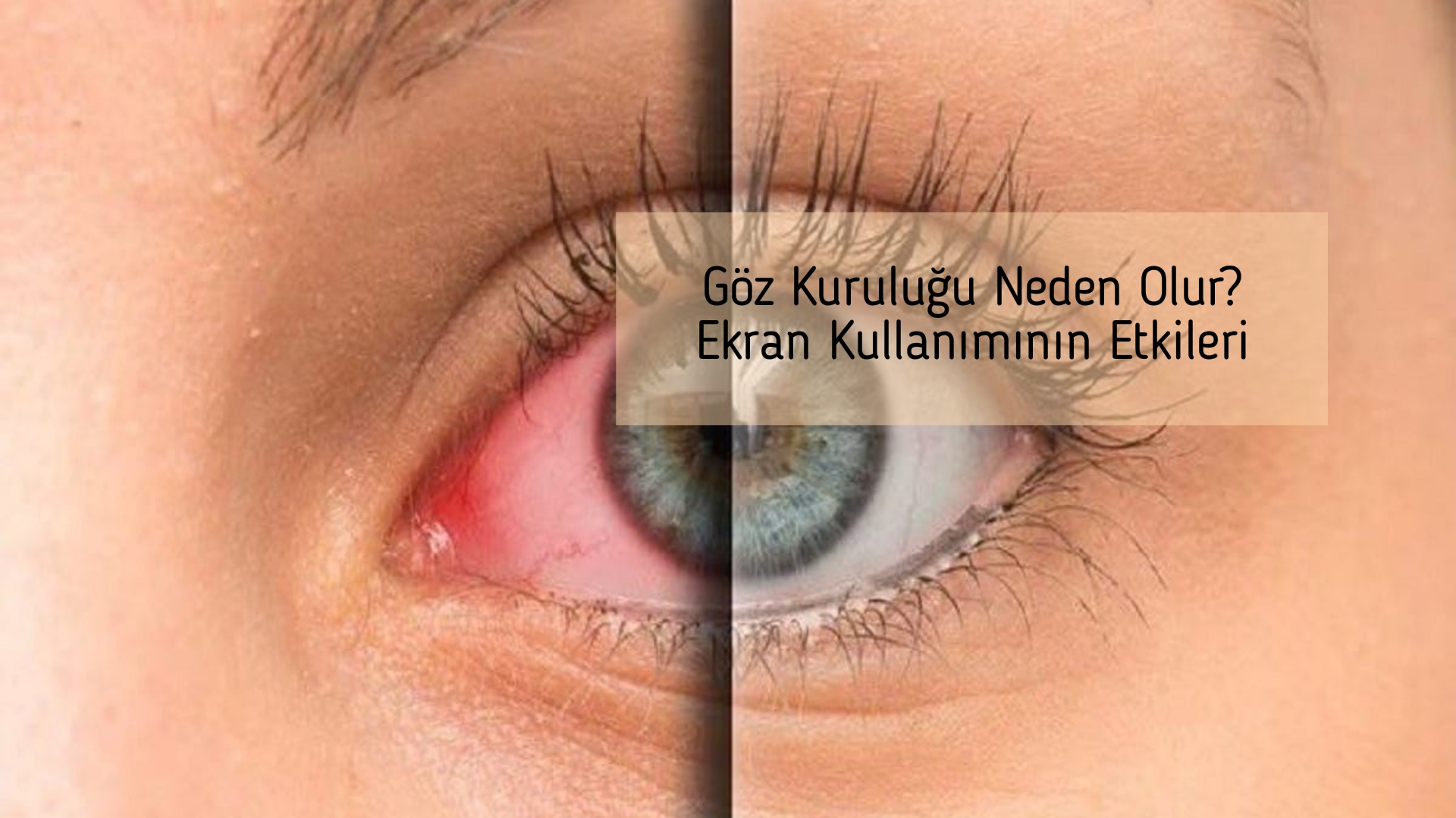 Göz Kuruluğu Neden Olur? Ekran Kullanımının Etkileri