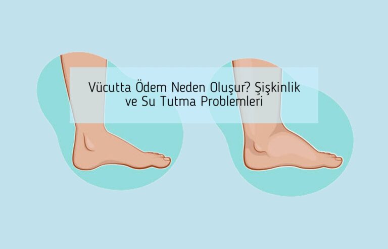 Vücutta Ödem Neden Oluşur? Şişkinlik ve Su Tutma Problemleri